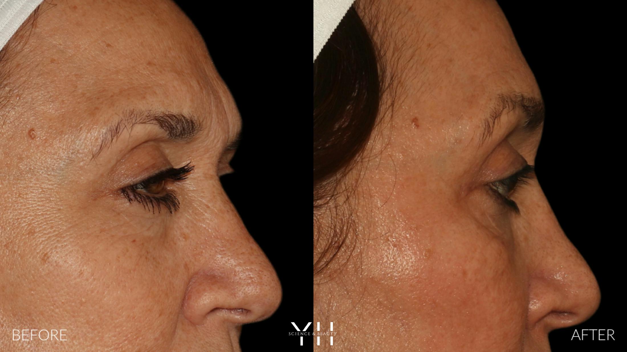 Blepharoplasty Before & After Gallery - Patient 121670069 - Image 3