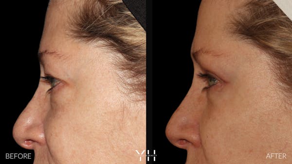  Blepharoplasty Before & After Gallery - Patient 222019 - Image 5
