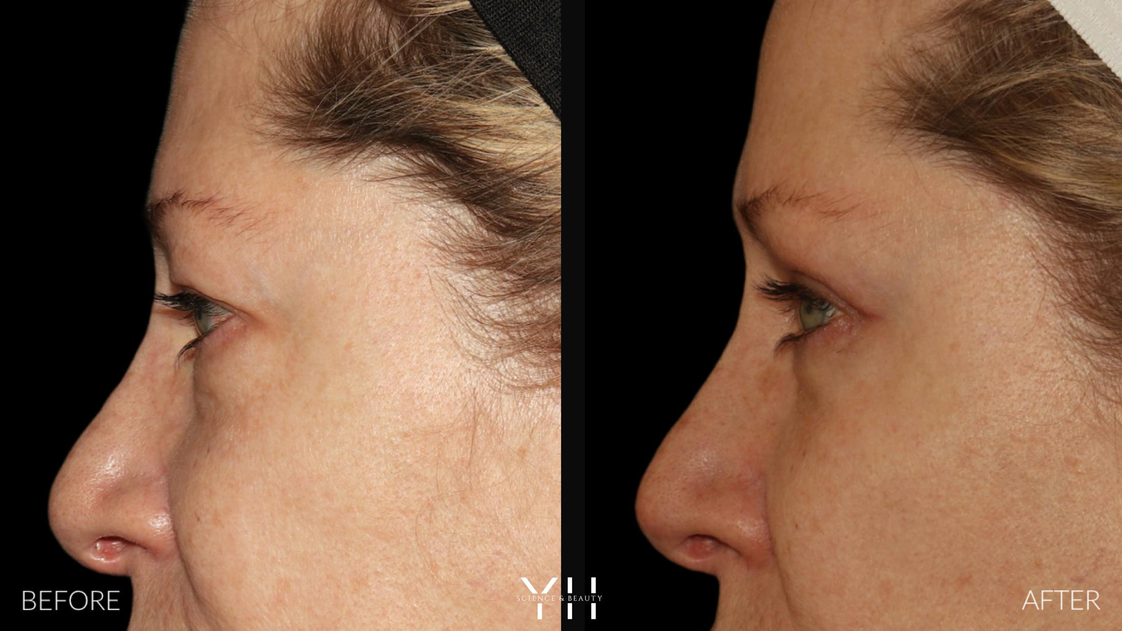 Blepharoplasty Before & After Gallery - Patient 222019 - Image 5
