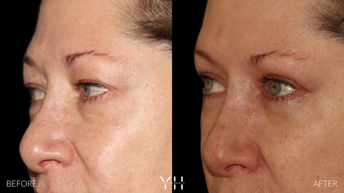  Blepharoplasty Before & After Gallery - Patient 222019 - Image 4