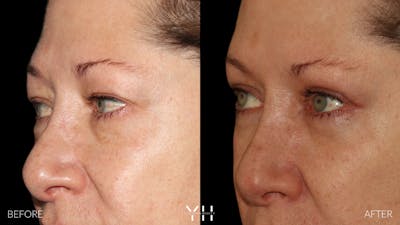  Blepharoplasty Before & After Gallery - Patient 222019 - Image 4