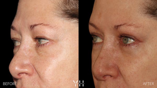 Blepharoplasty Before & After Gallery - Patient 222019 - Image 4