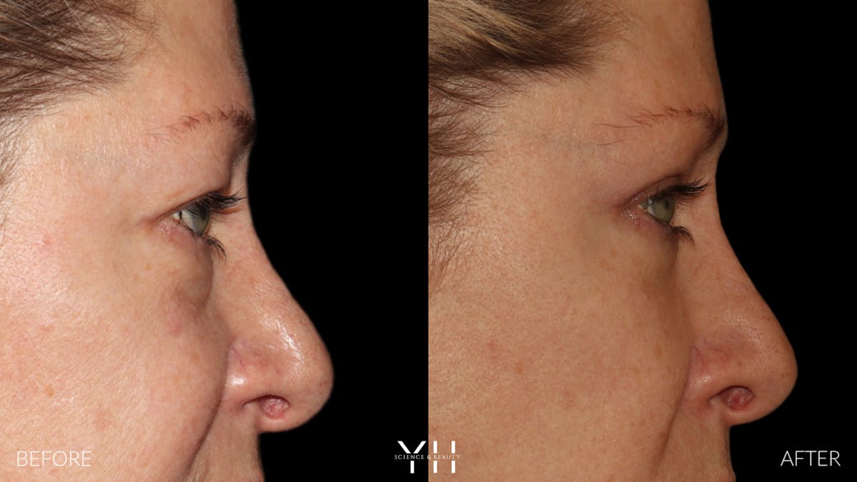  Blepharoplasty Before & After Gallery - Patient 222019 - Image 3