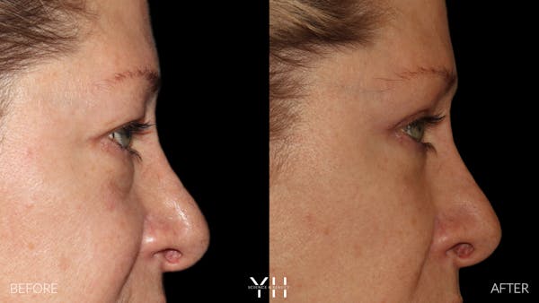  Blepharoplasty Before & After Gallery - Patient 222019 - Image 3