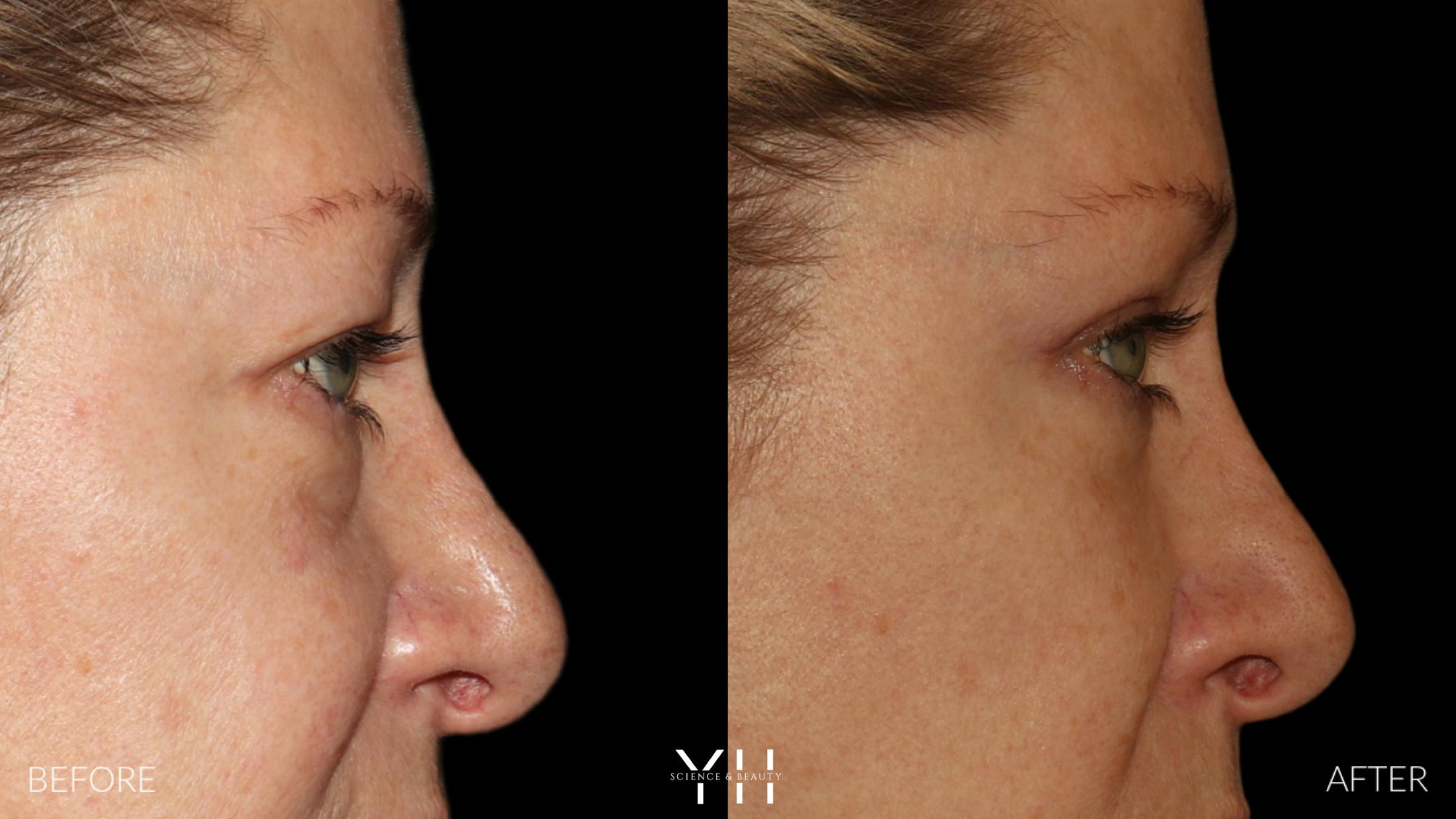 Blepharoplasty Before & After Gallery - Patient 222019 - Image 3