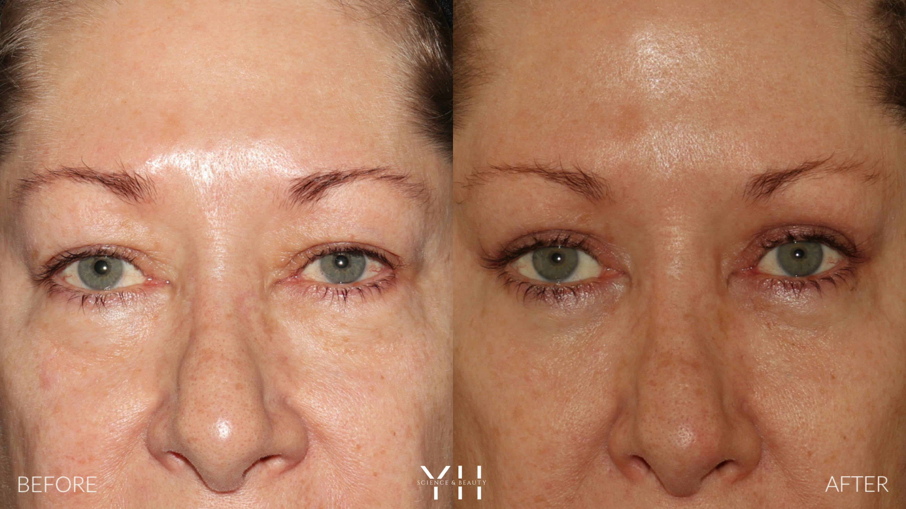 Before and After Eyelid Surgery