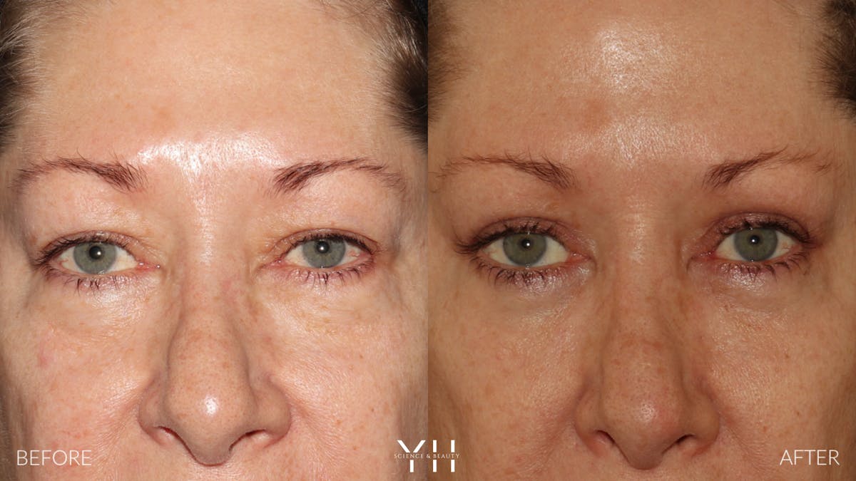  Blepharoplasty Before & After Gallery - Patient 222019 - Image 1