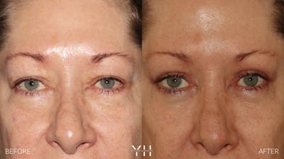  Blepharoplasty Before & After Gallery - Patient 222019 - Image 1