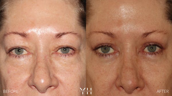  Blepharoplasty Before & After Gallery - Patient 222019 - Image 1