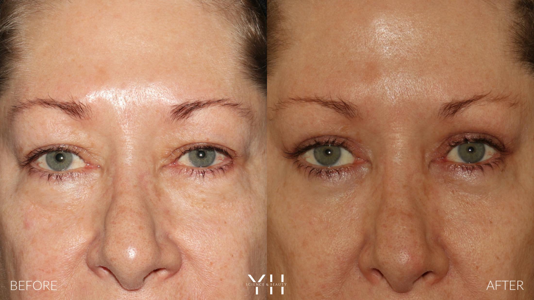 Blepharoplasty Before & After Gallery - Patient 222019 - Image 1