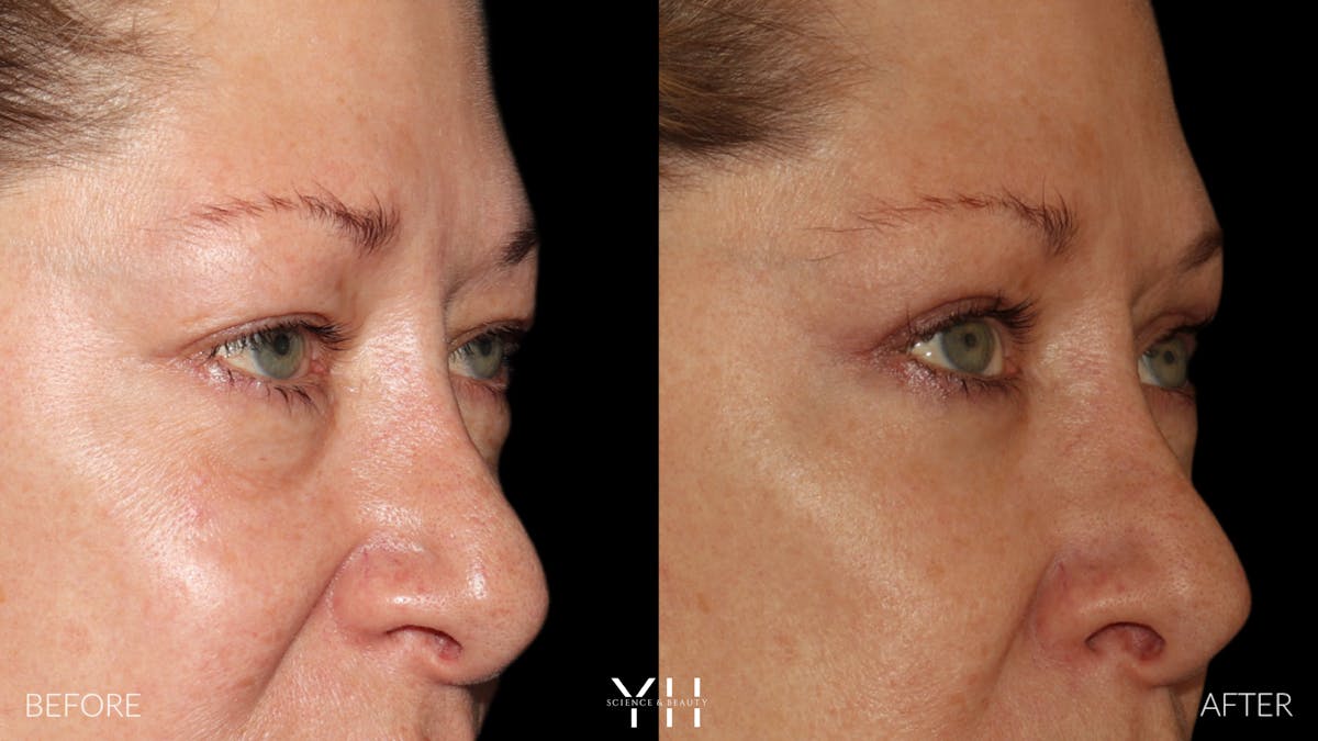  Blepharoplasty Before & After Gallery - Patient 222019 - Image 2