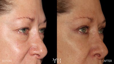  Blepharoplasty Before & After Gallery - Patient 222019 - Image 2