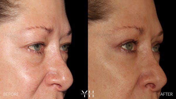  Blepharoplasty Before & After Gallery - Patient 222019 - Image 2