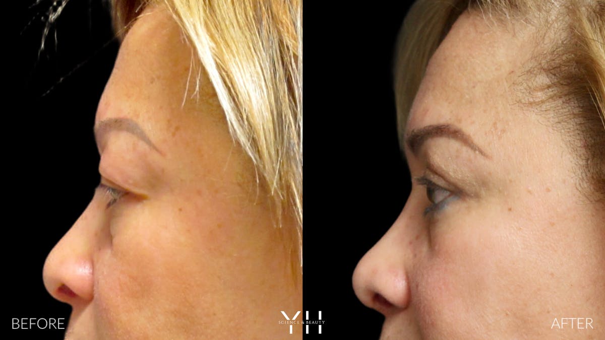  Blepharoplasty Before & After Gallery - Patient 25274657 - Image 5