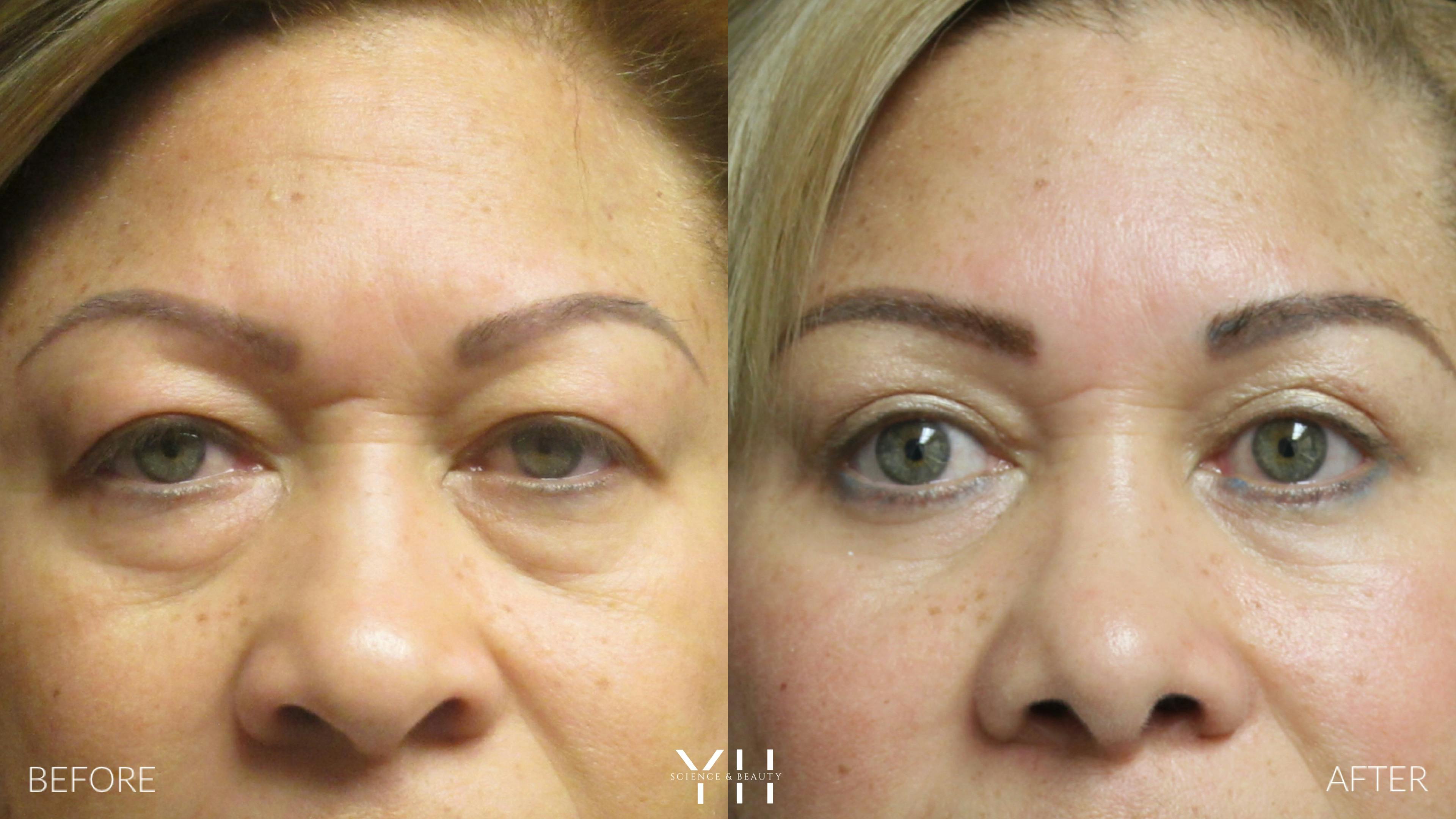 Before and After Eyelid Surgery
