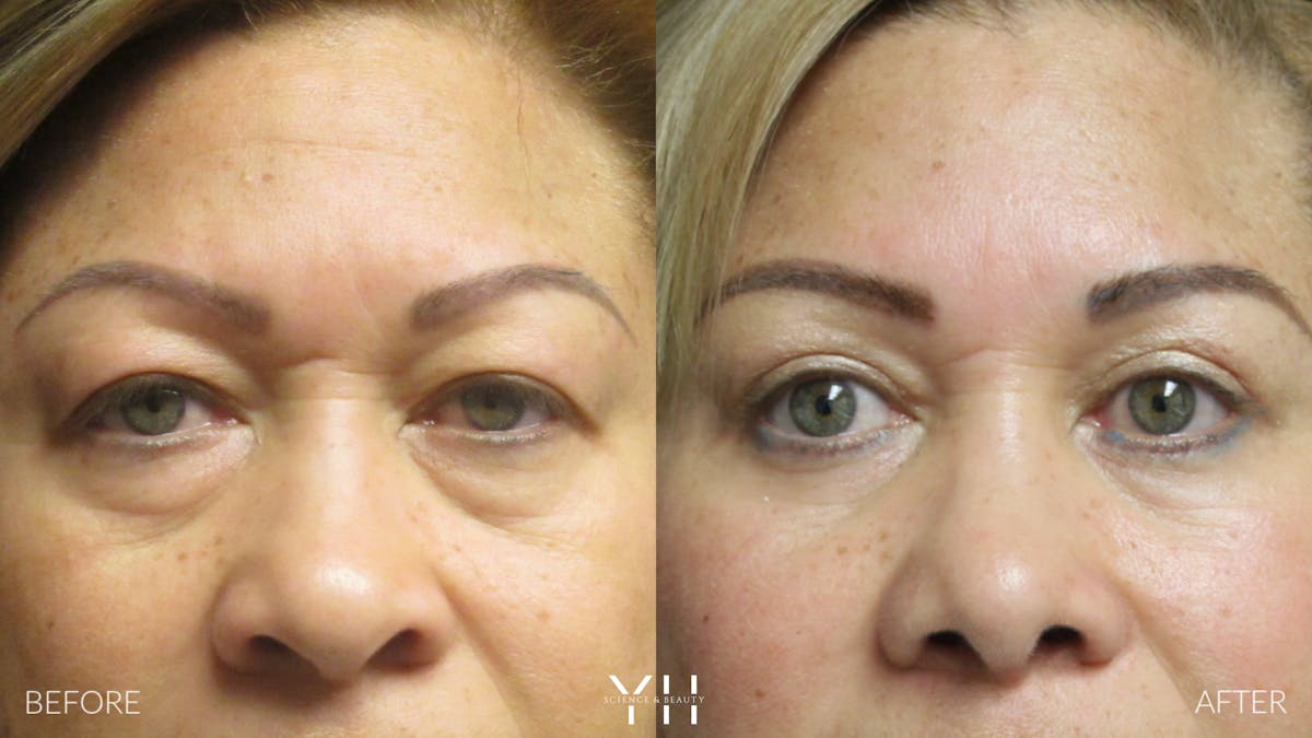  Blepharoplasty Before & After Gallery - Patient 25274657 - Image 1