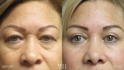 Blepharoplasty Before & After Gallery - Patient 25274657 - Image 1