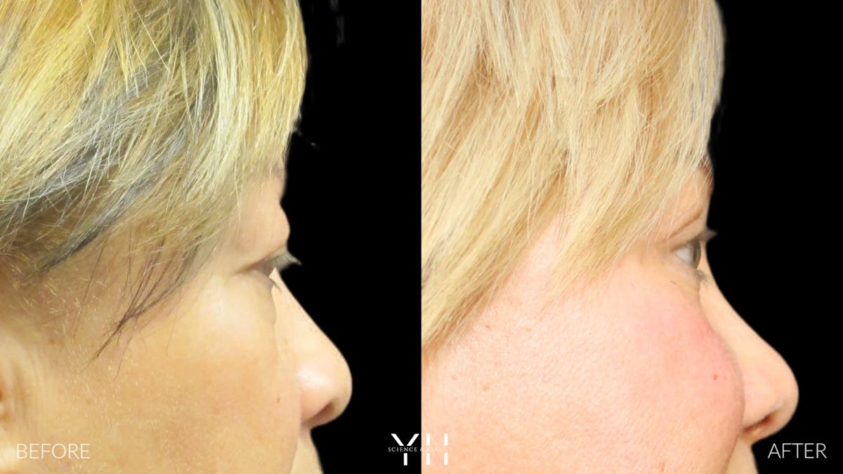  Blepharoplasty Before & After Gallery - Patient 25274657 - Image 3