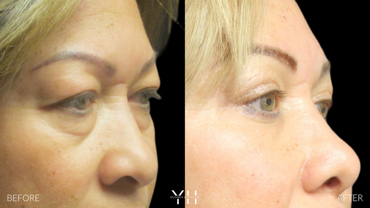  Blepharoplasty Before & After Gallery - Patient 25274657 - Image 2