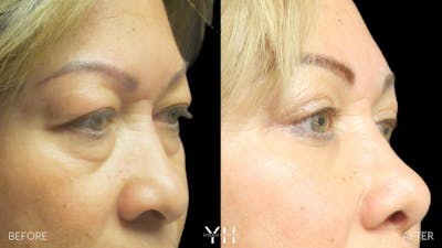  Blepharoplasty Before & After Gallery - Patient 25274657 - Image 2