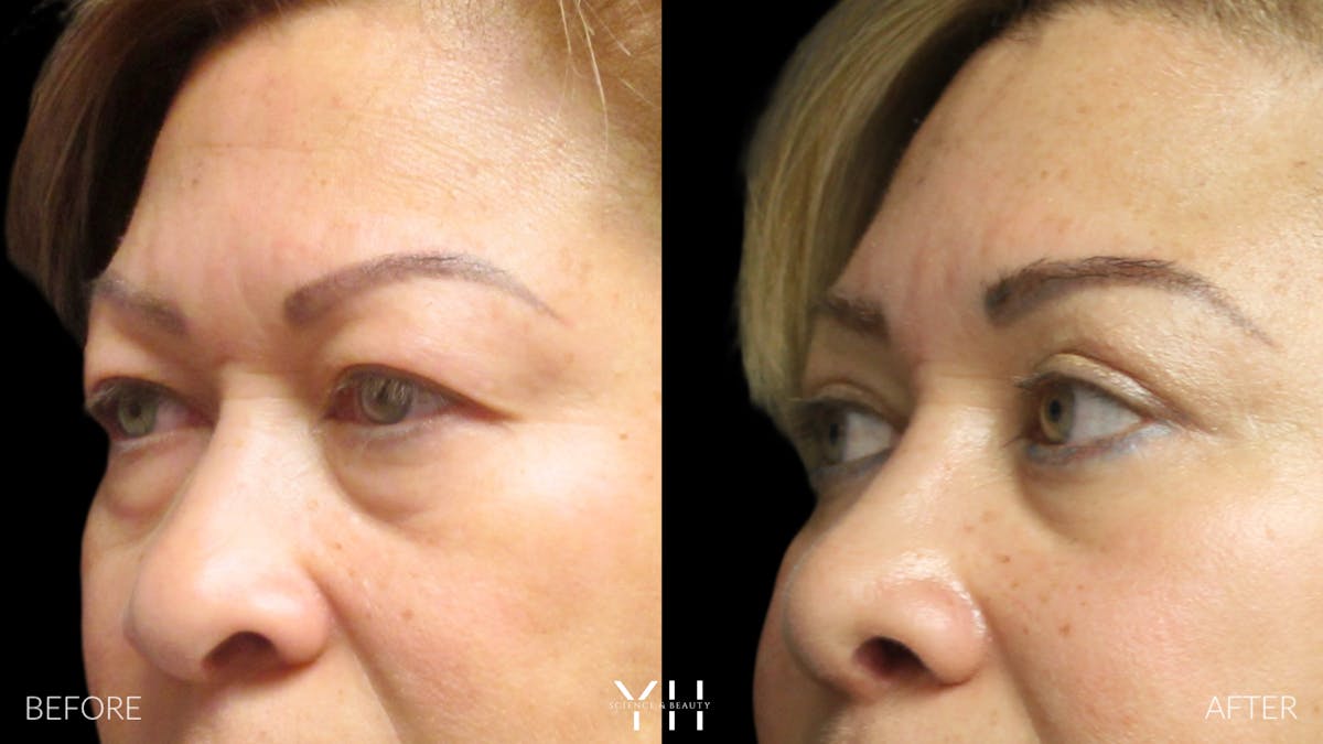  Blepharoplasty Before & After Gallery - Patient 25274657 - Image 4