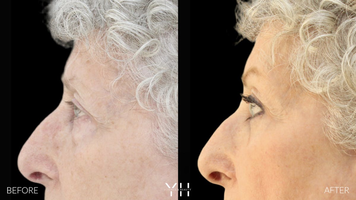  Blepharoplasty Before & After Gallery - Patient 164986 - Image 5