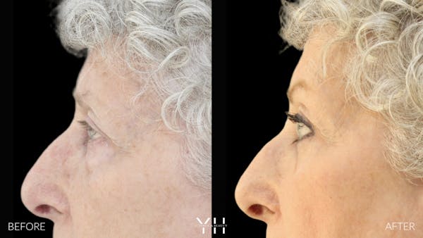  Blepharoplasty Before & After Gallery - Patient 164986 - Image 5