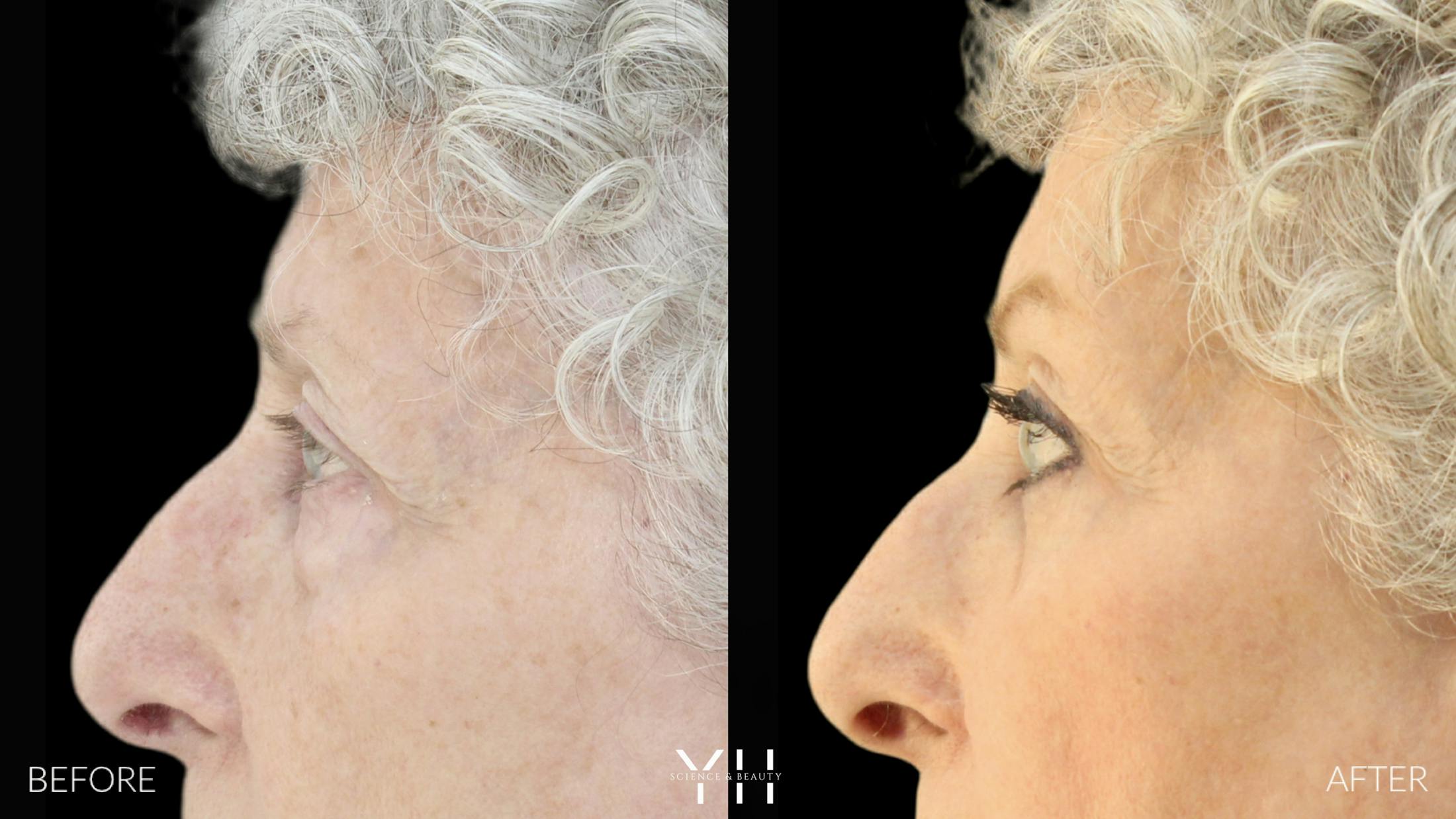 Blepharoplasty Before & After Gallery - Patient 164986 - Image 5