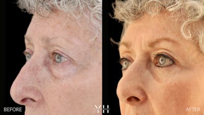  Blepharoplasty Before & After Gallery - Patient 164986 - Image 4