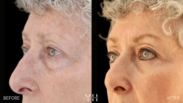  Blepharoplasty Before & After Gallery - Patient 164986 - Image 4