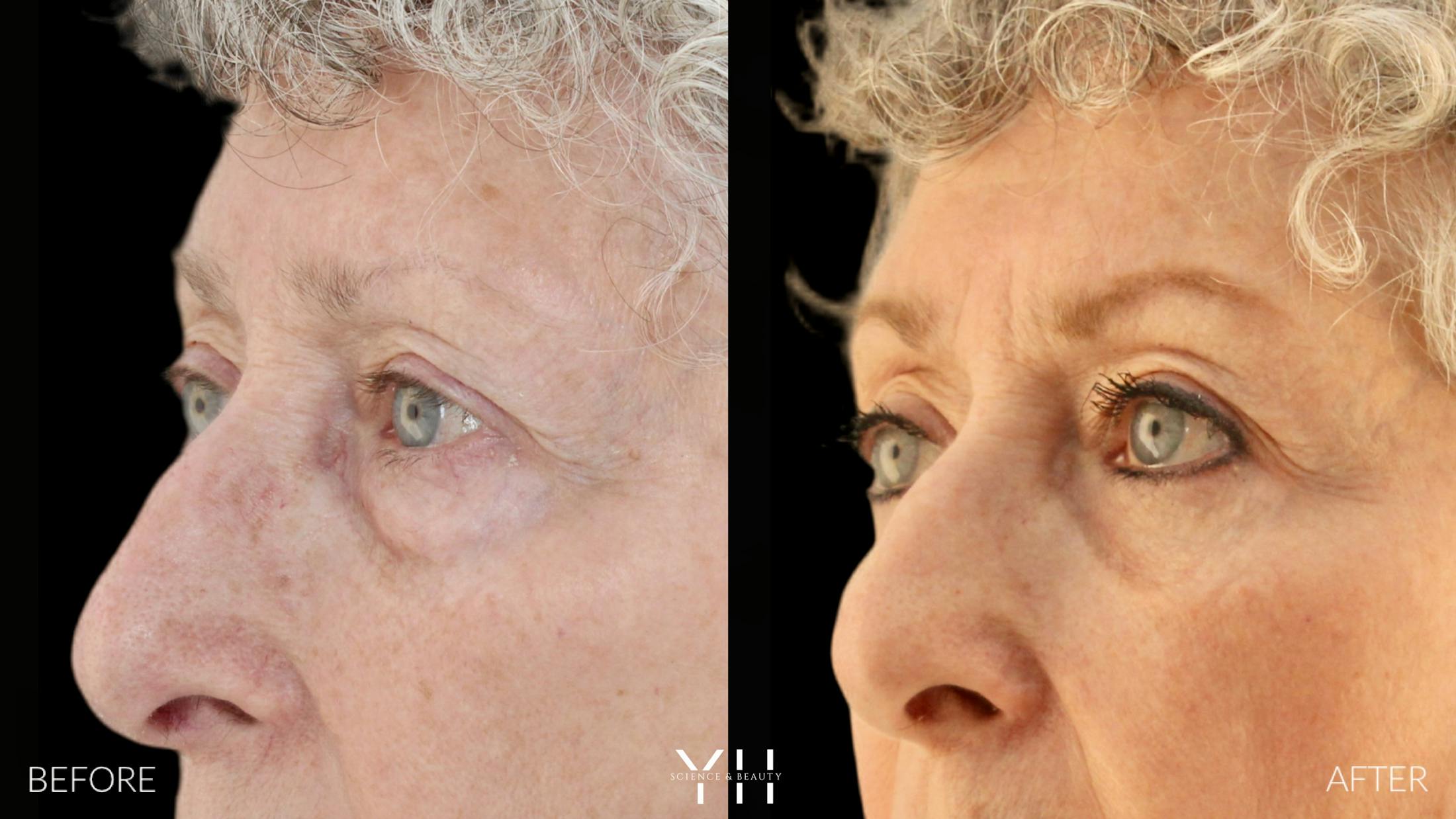 Blepharoplasty Before & After Gallery - Patient 164986 - Image 4