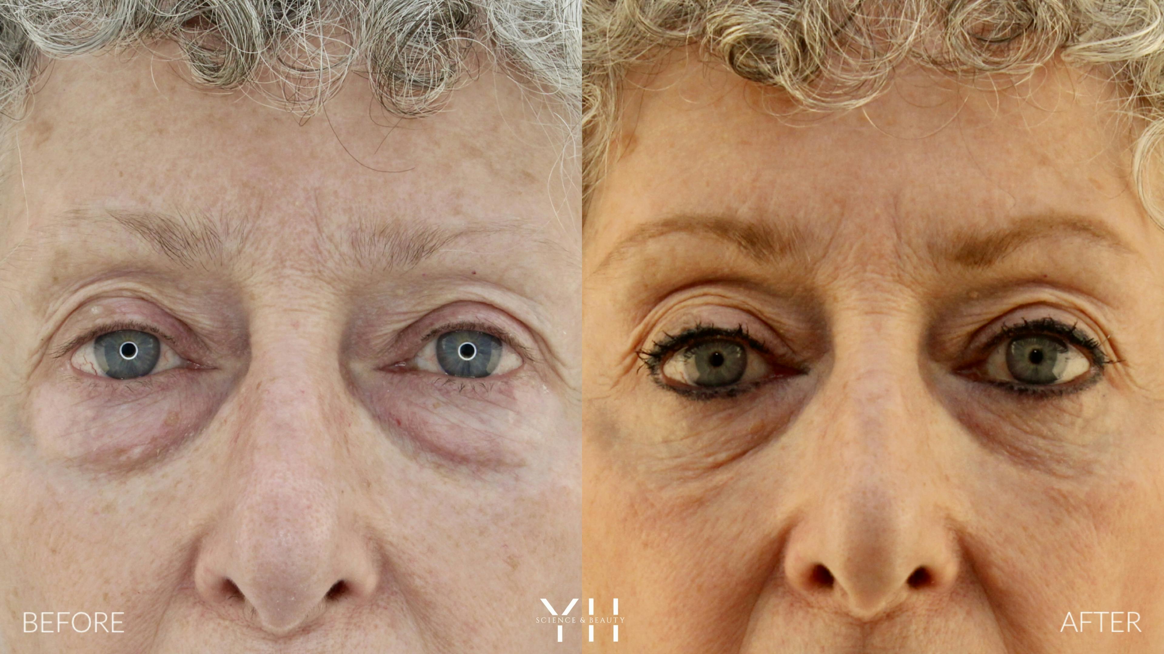 Before and After Eyelid Surgery