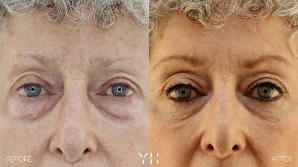  Blepharoplasty Before & After Gallery - Patient 164986 - Image 1