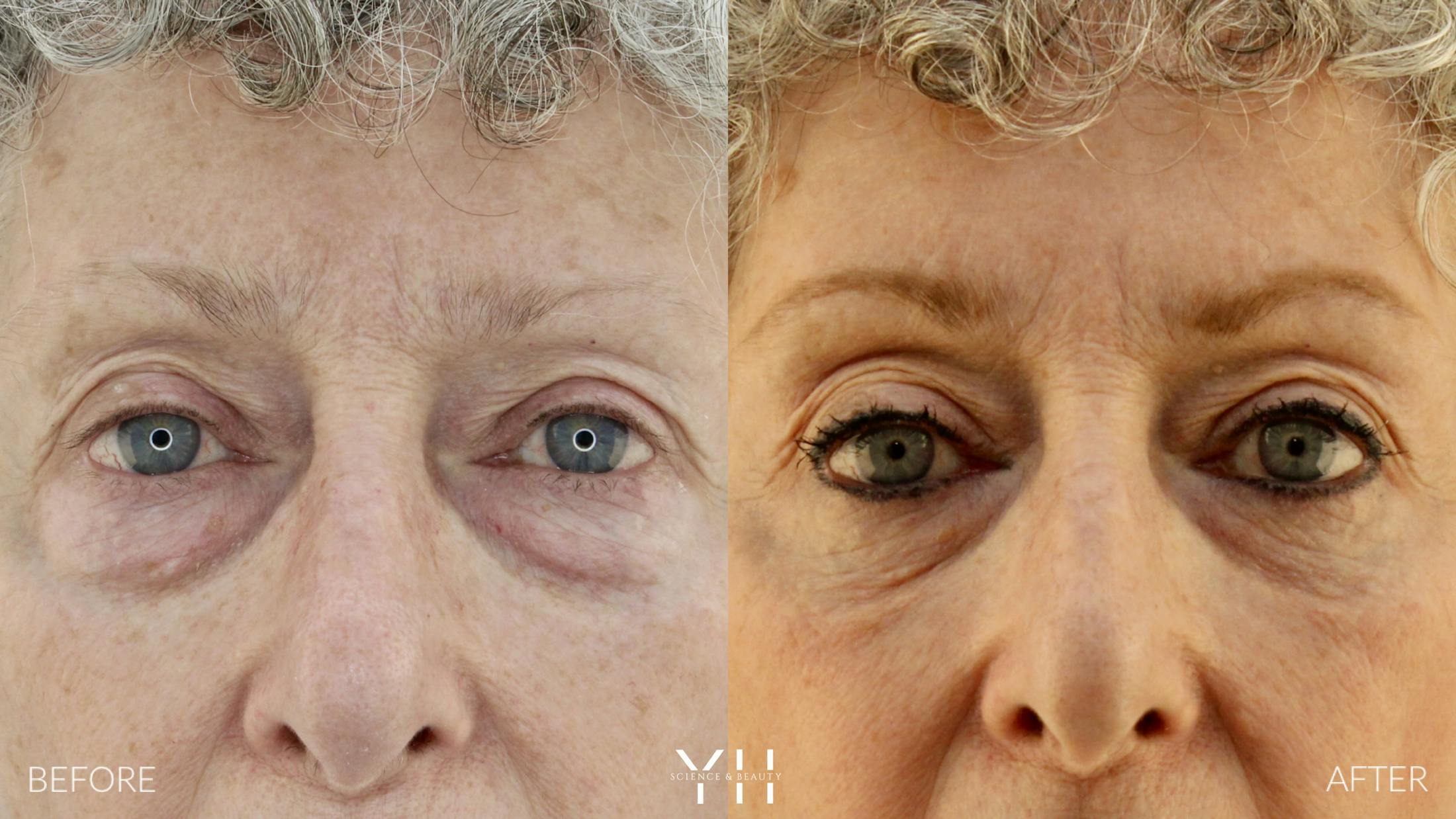 Blepharoplasty Before & After Gallery - Patient 164986 - Image 1