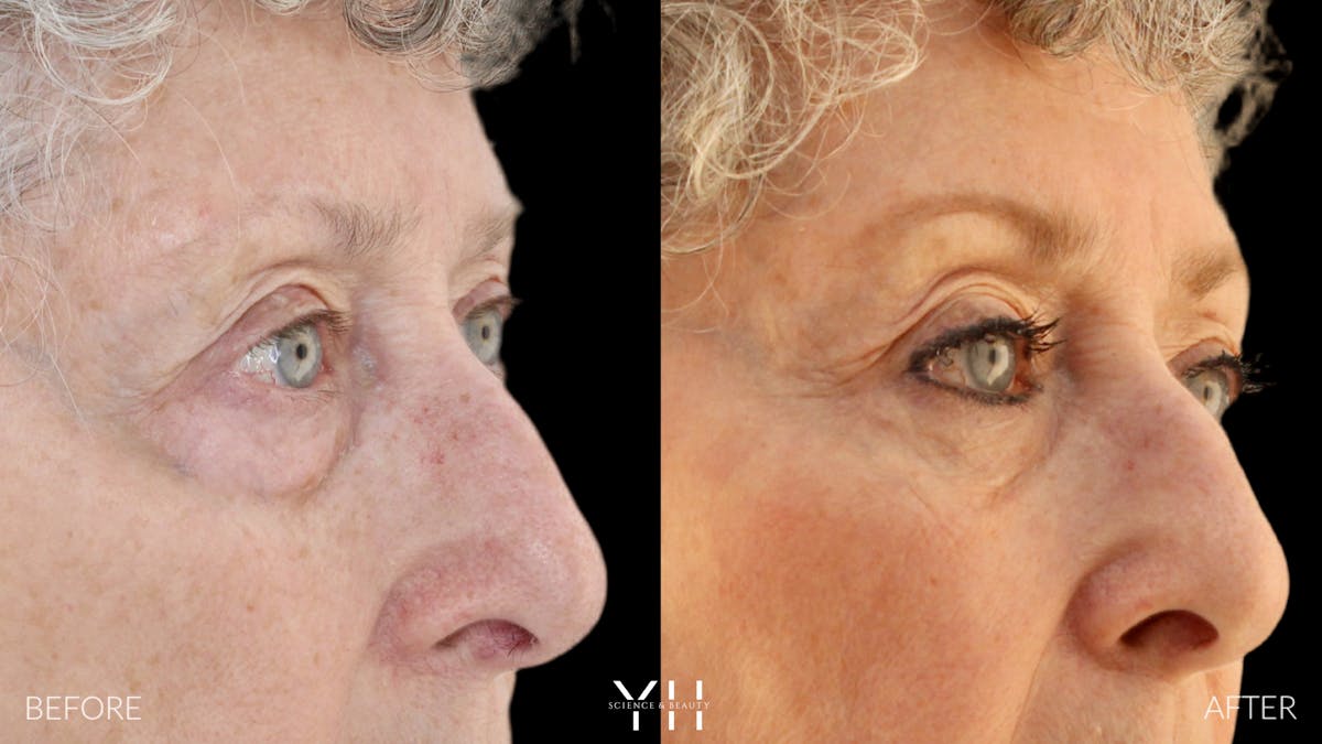  Blepharoplasty Before & After Gallery - Patient 164986 - Image 2