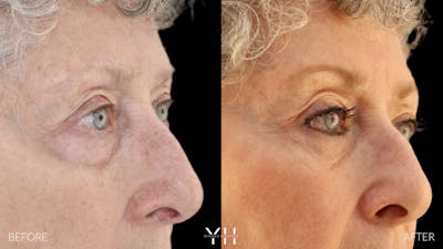  Blepharoplasty Before & After Gallery - Patient 164986 - Image 2