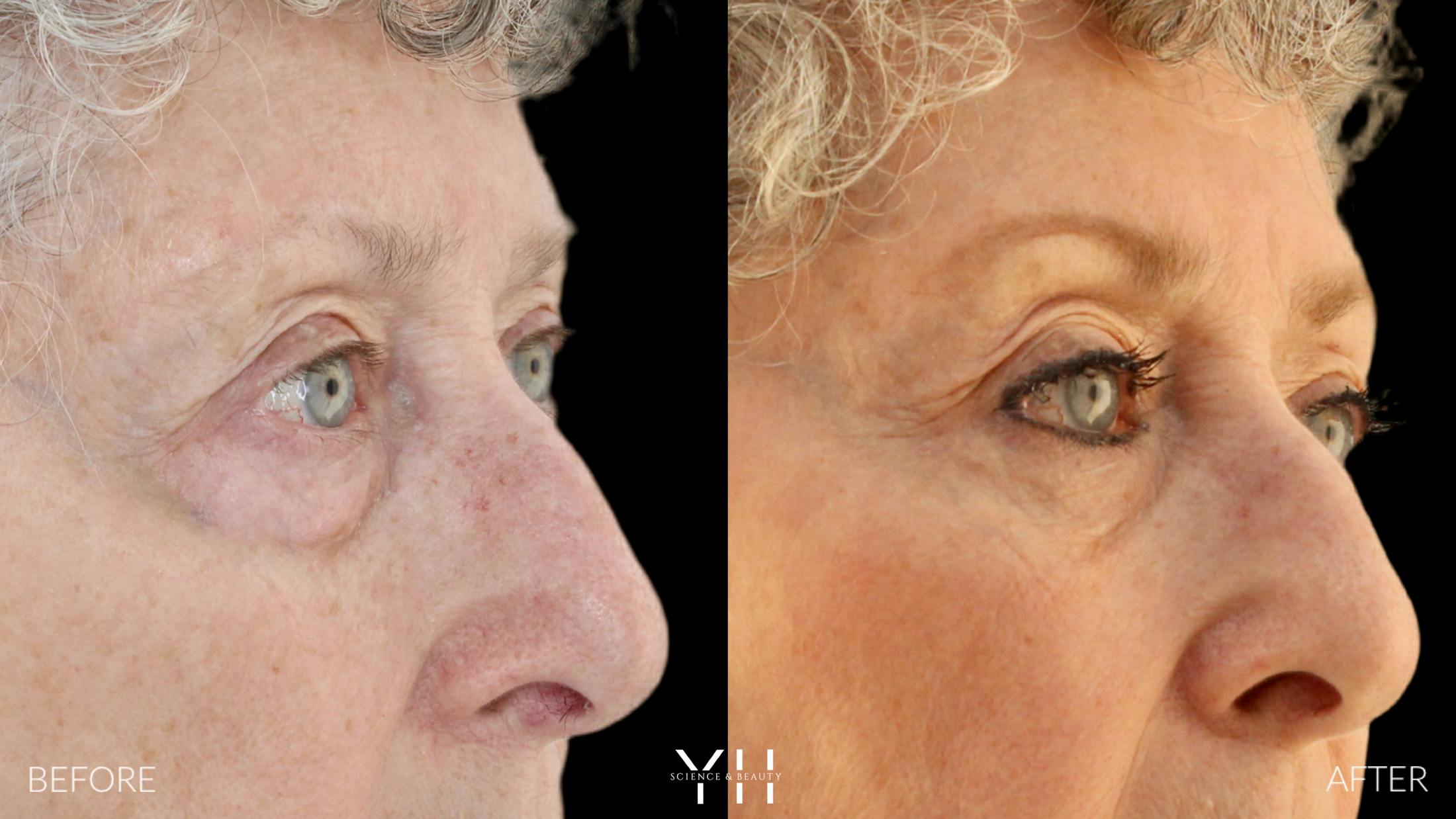 Blepharoplasty Before & After Gallery - Patient 164986 - Image 2