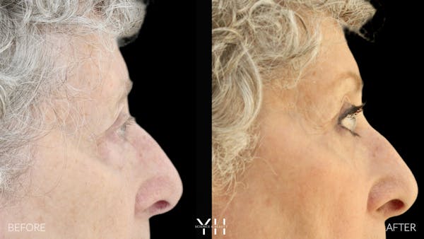 Blepharoplasty Before & After Gallery - Patient 164986 - Image 3