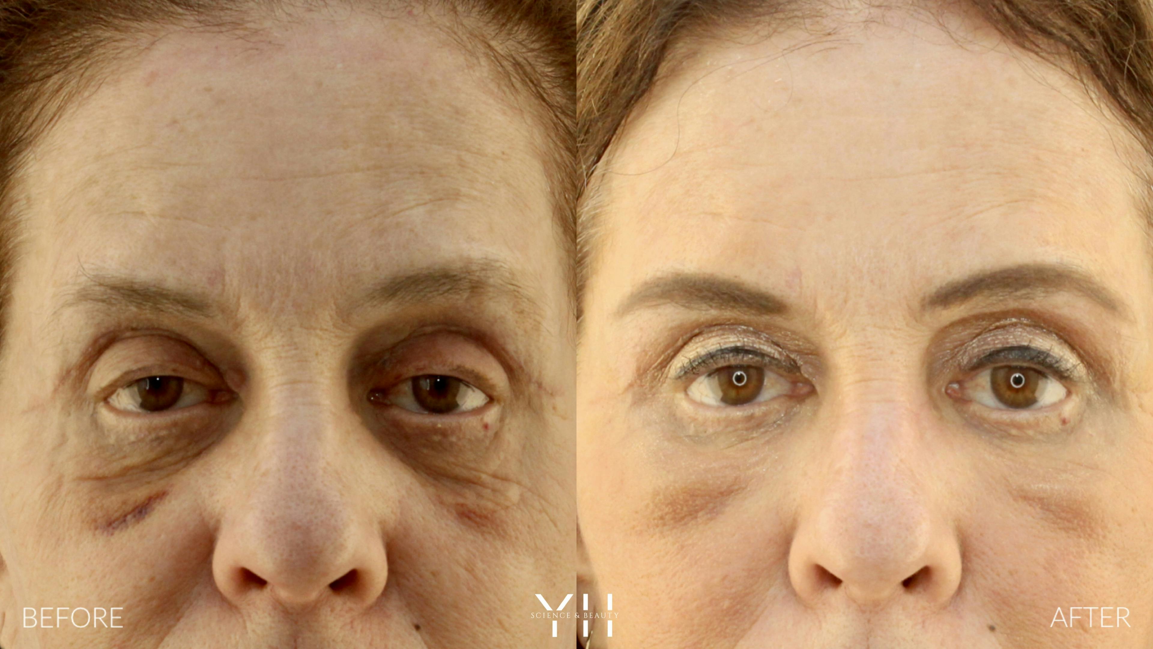 Before and After Eyelid Surgery