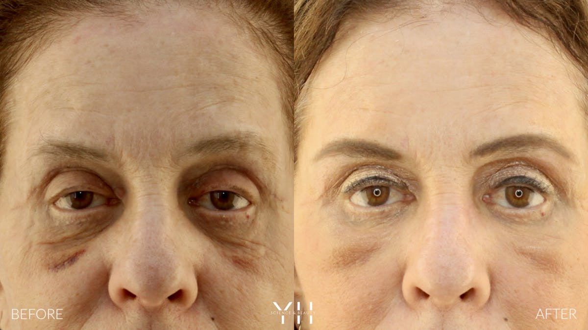  Blepharoplasty Before & After Gallery - Patient 124984 - Image 1