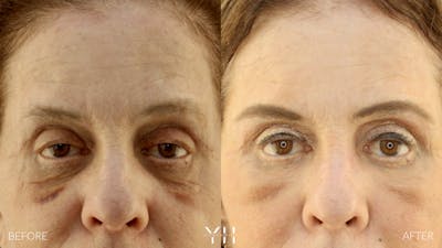  Blepharoplasty Before & After Gallery - Patient 124984 - Image 1