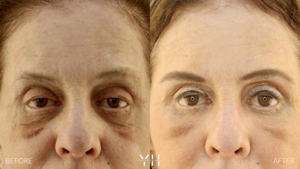  Blepharoplasty Before & After Gallery - Patient 124984 - Image 1