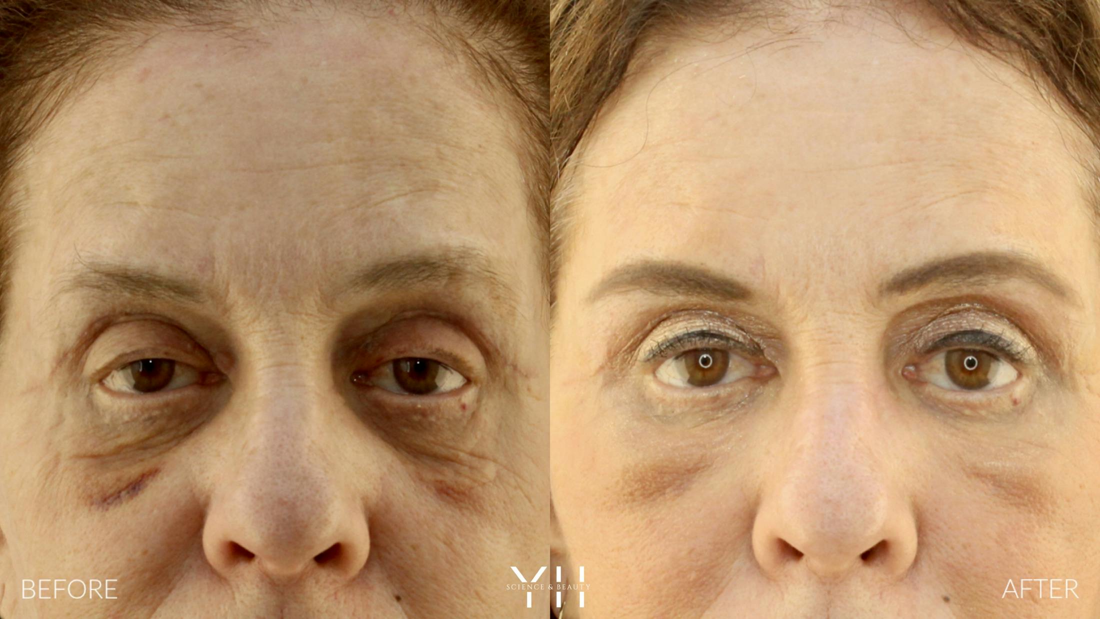 Blepharoplasty Before & After Gallery - Patient 124984 - Image 1