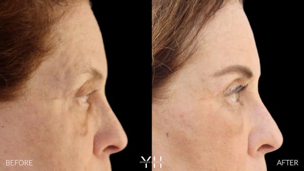  Blepharoplasty Before & After Gallery - Patient 124984 - Image 3