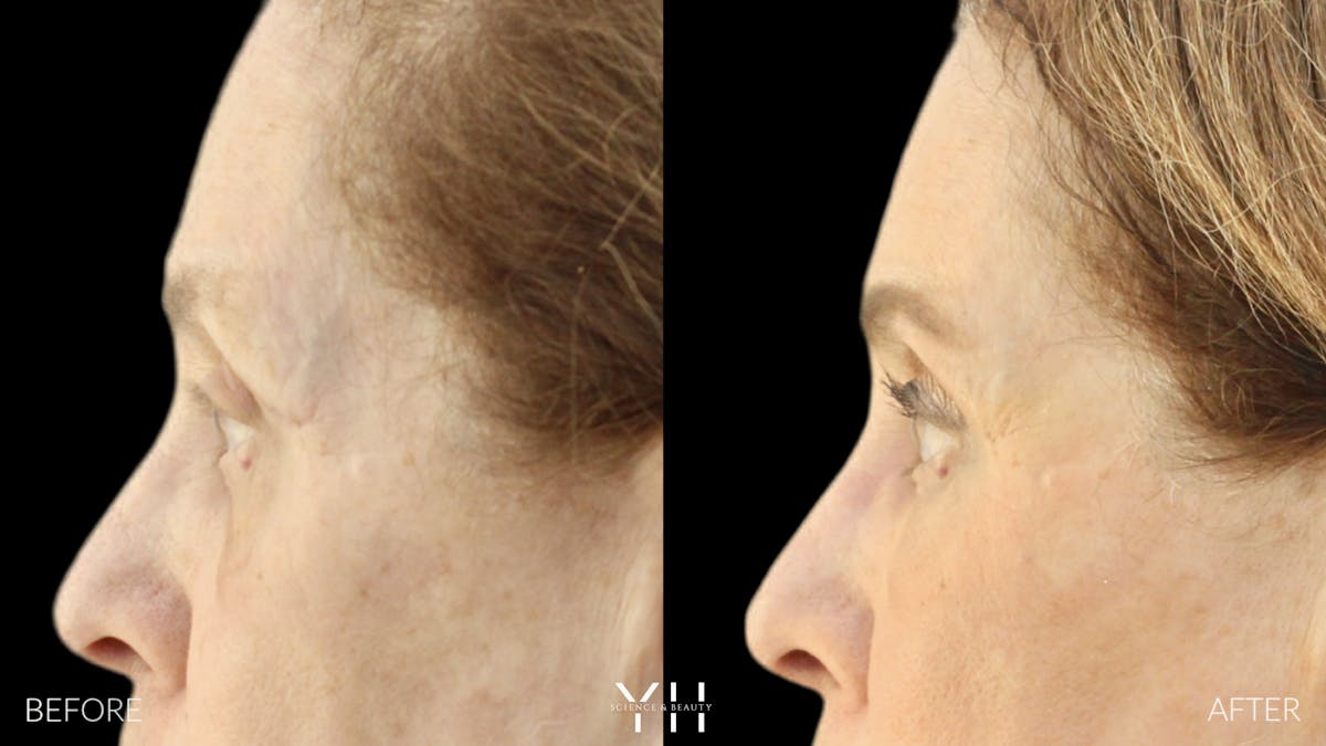  Blepharoplasty Before & After Gallery - Patient 124984 - Image 5