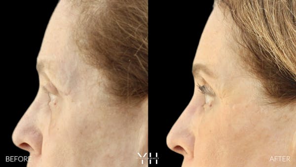  Blepharoplasty Before & After Gallery - Patient 124984 - Image 5