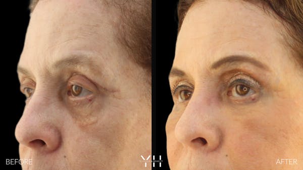  Blepharoplasty Before & After Gallery - Patient 124984 - Image 4