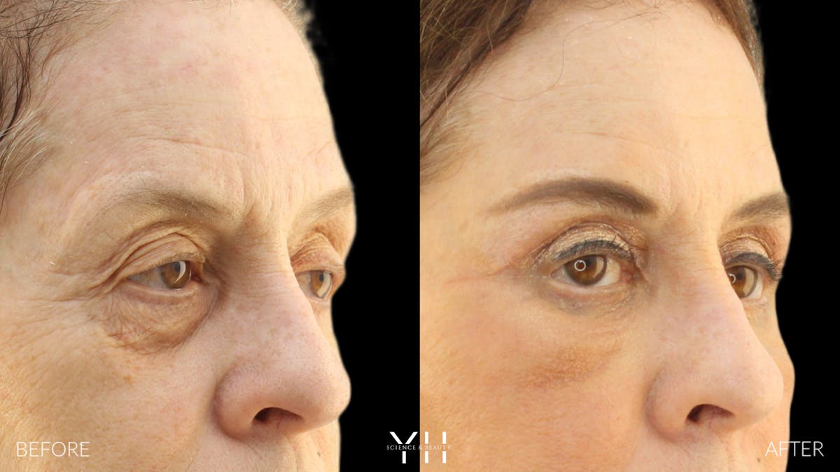  Blepharoplasty Before & After Gallery - Patient 124984 - Image 2