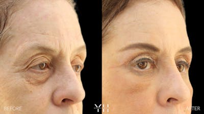  Blepharoplasty Before & After Gallery - Patient 124984 - Image 2