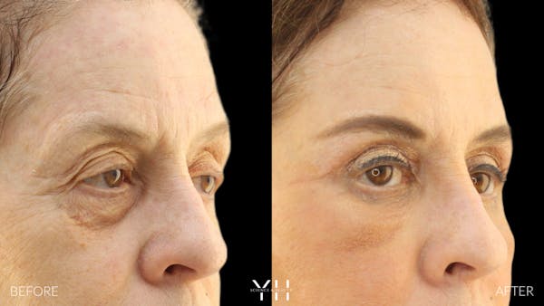  Blepharoplasty Before & After Gallery - Patient 124984 - Image 2